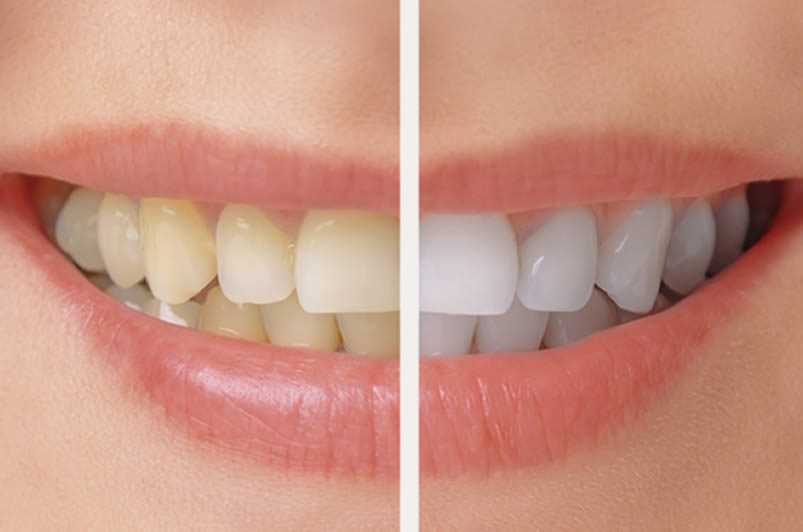 Bleaching Your Teeth