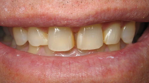 Smile Makeover - Before