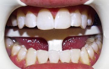 After Zoom Whitening