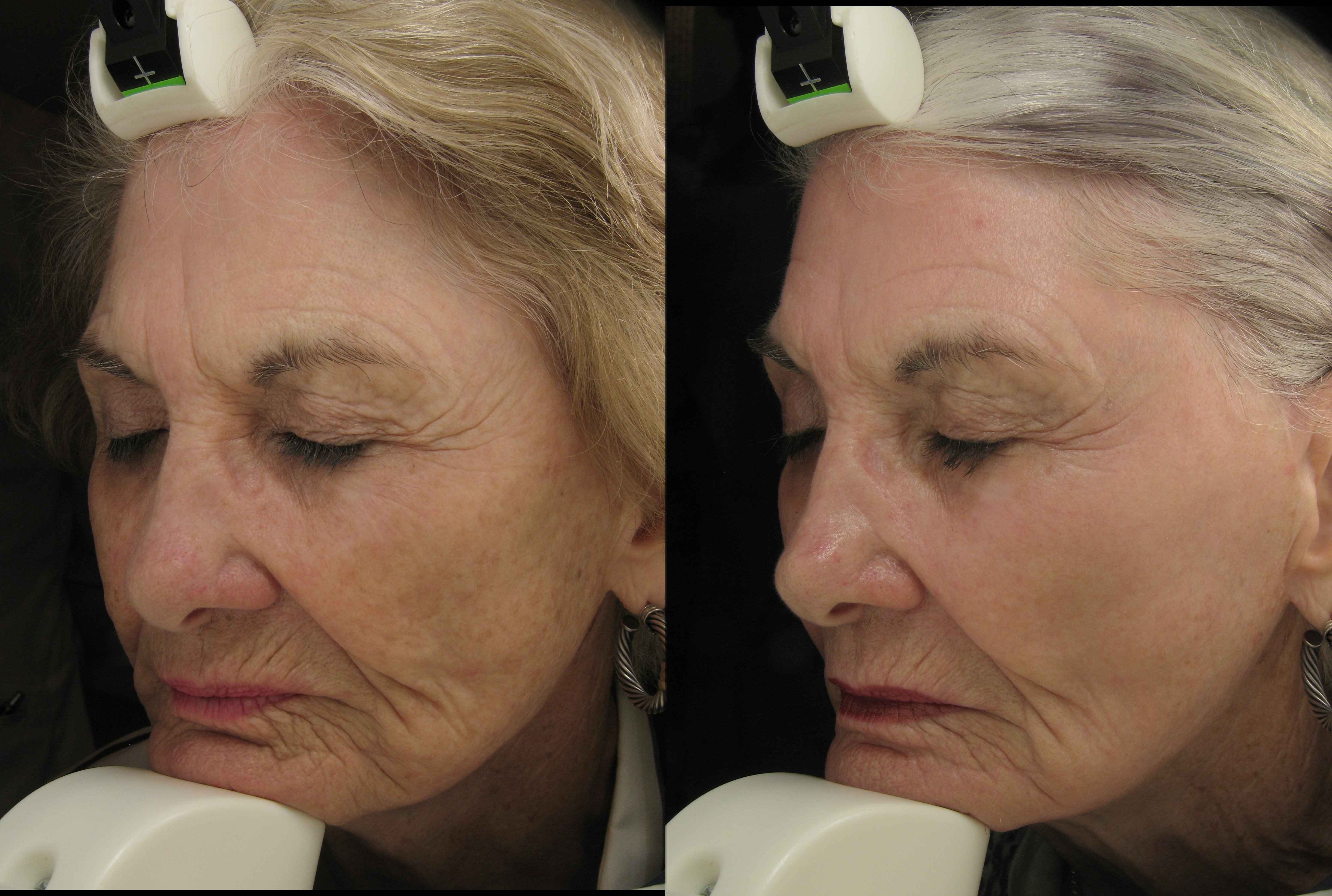 Laser Stretch Mark Removal Cost Los Angeles Directions