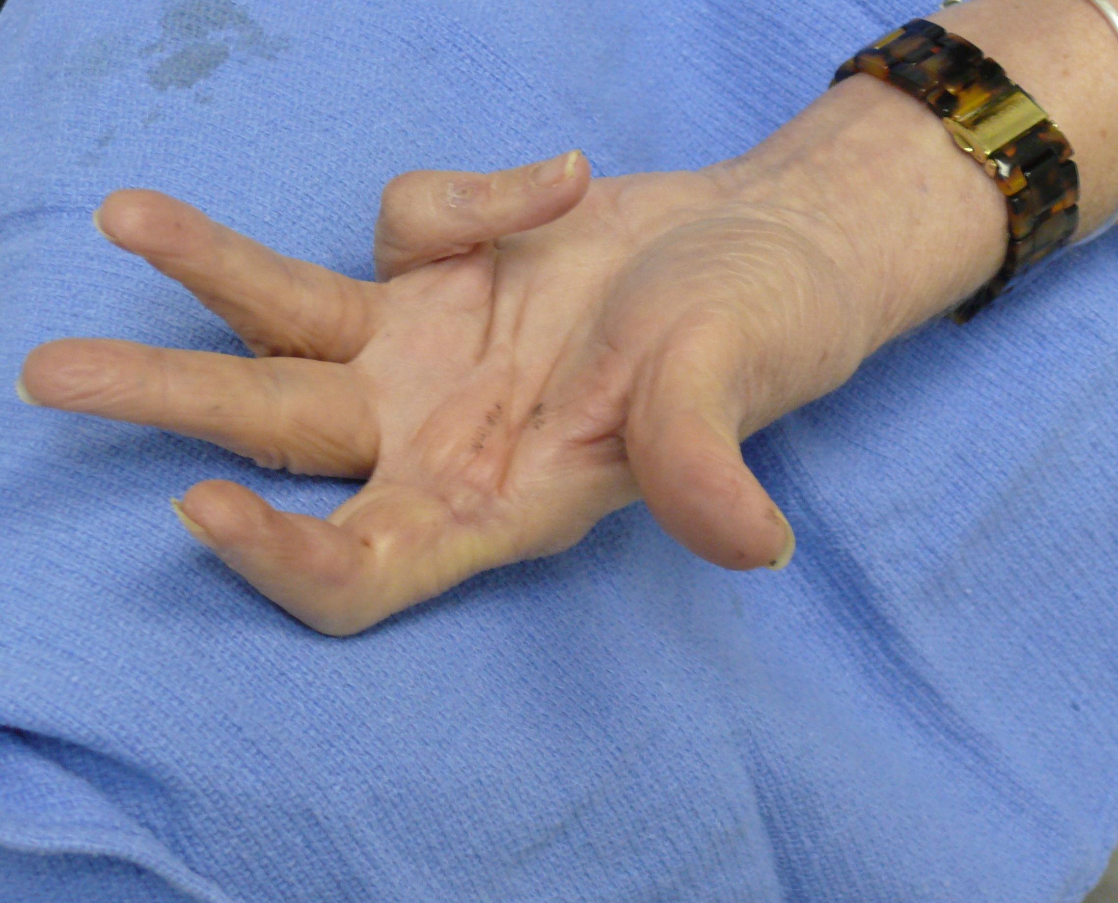 Before Needle Fasciotomy
