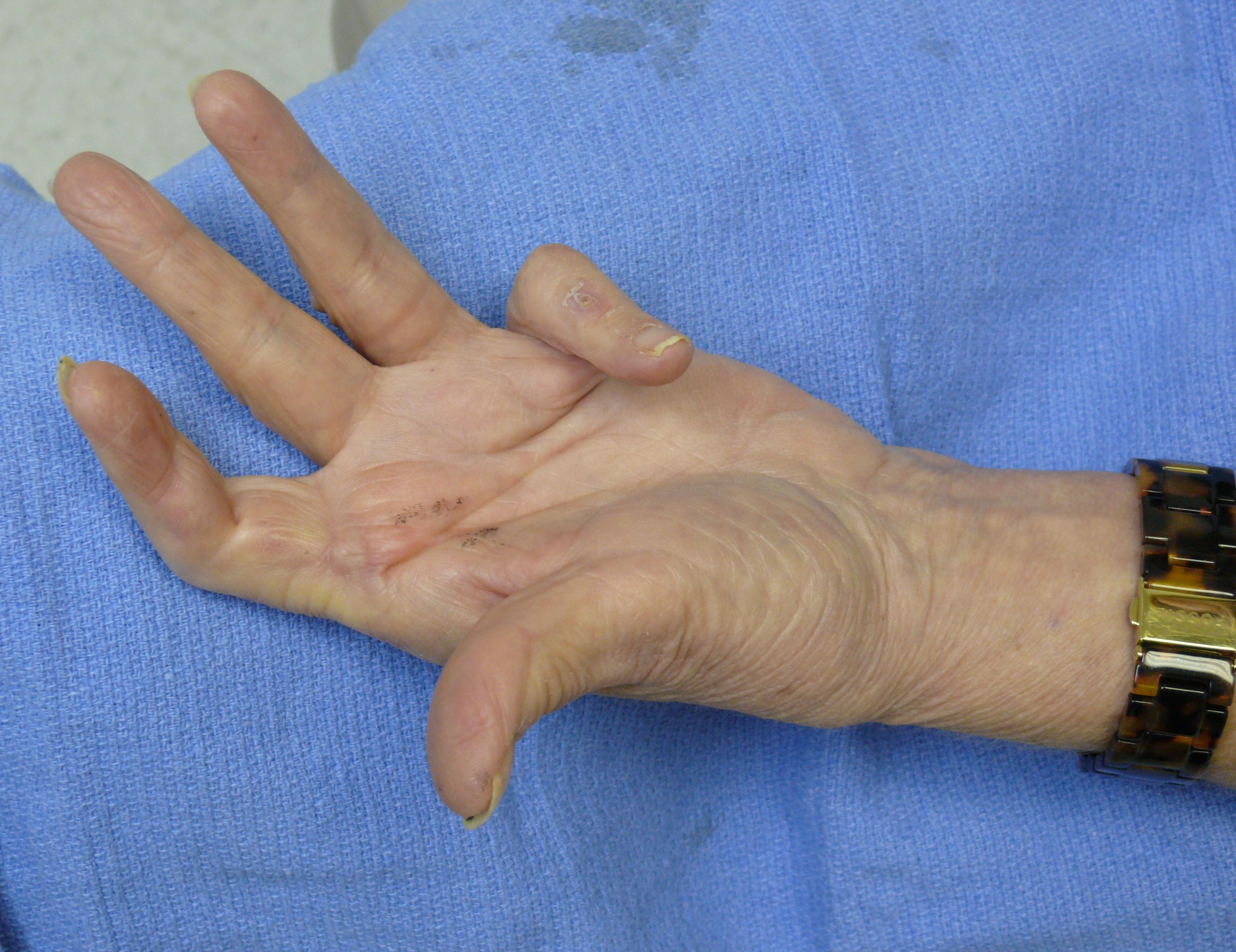 Before Needle Fasciotomy