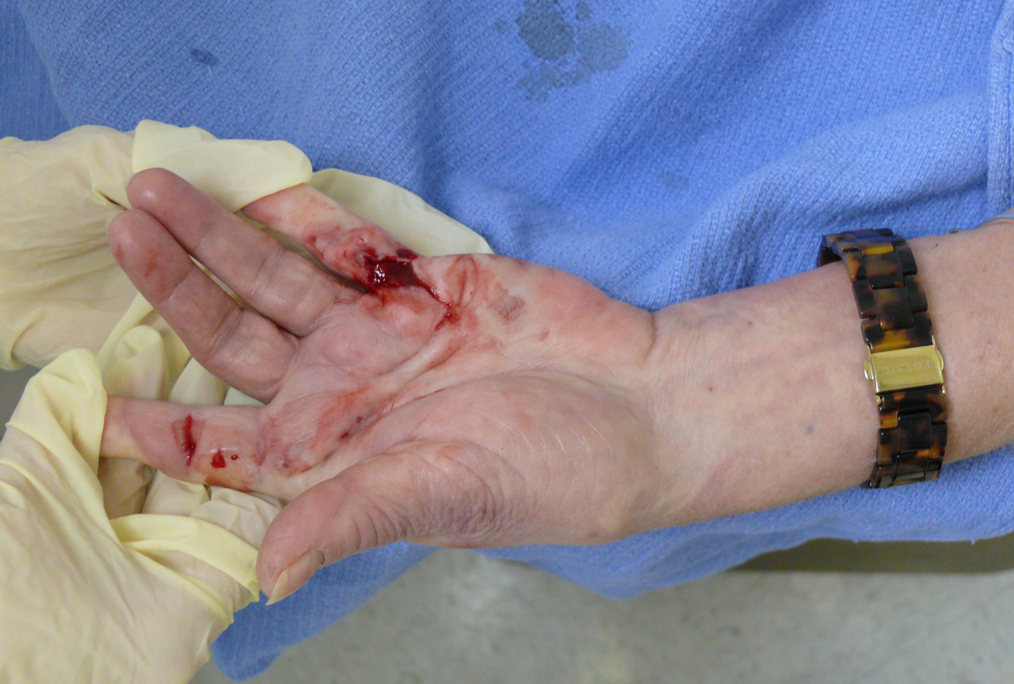 Post Op Needle Fasciotomy