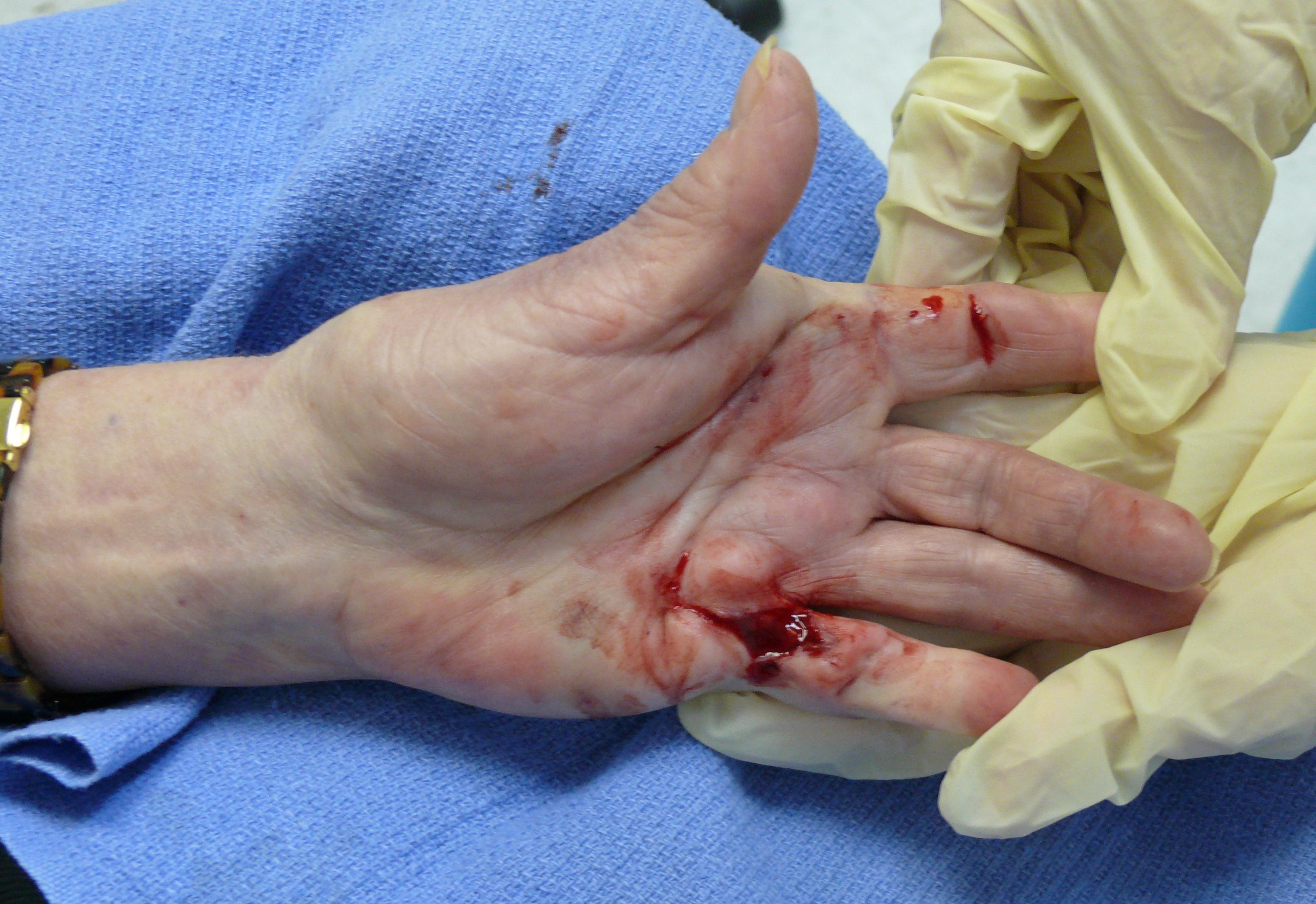 Post Op Needle Fasciotomy