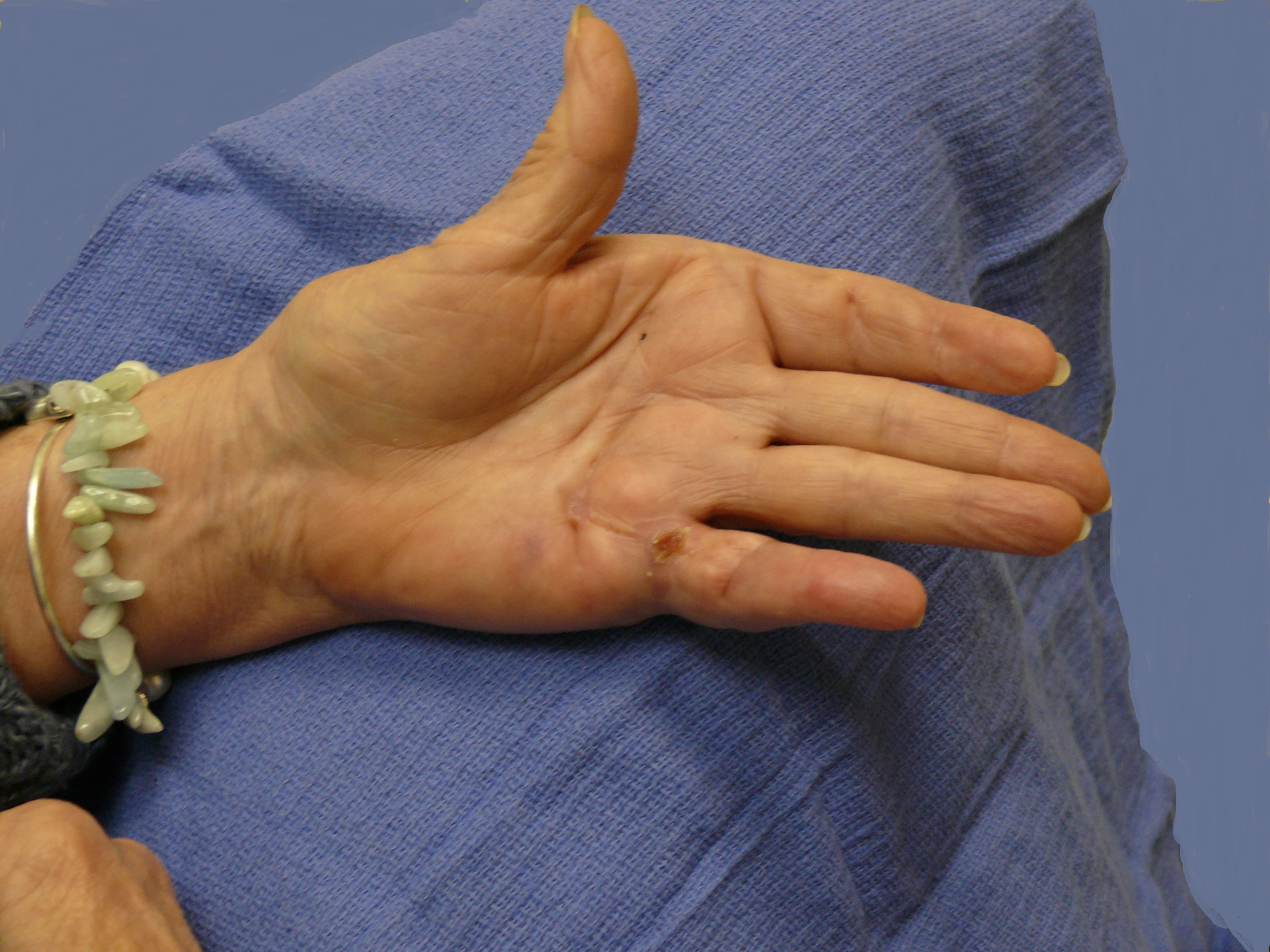 After Needle Fasciotomy