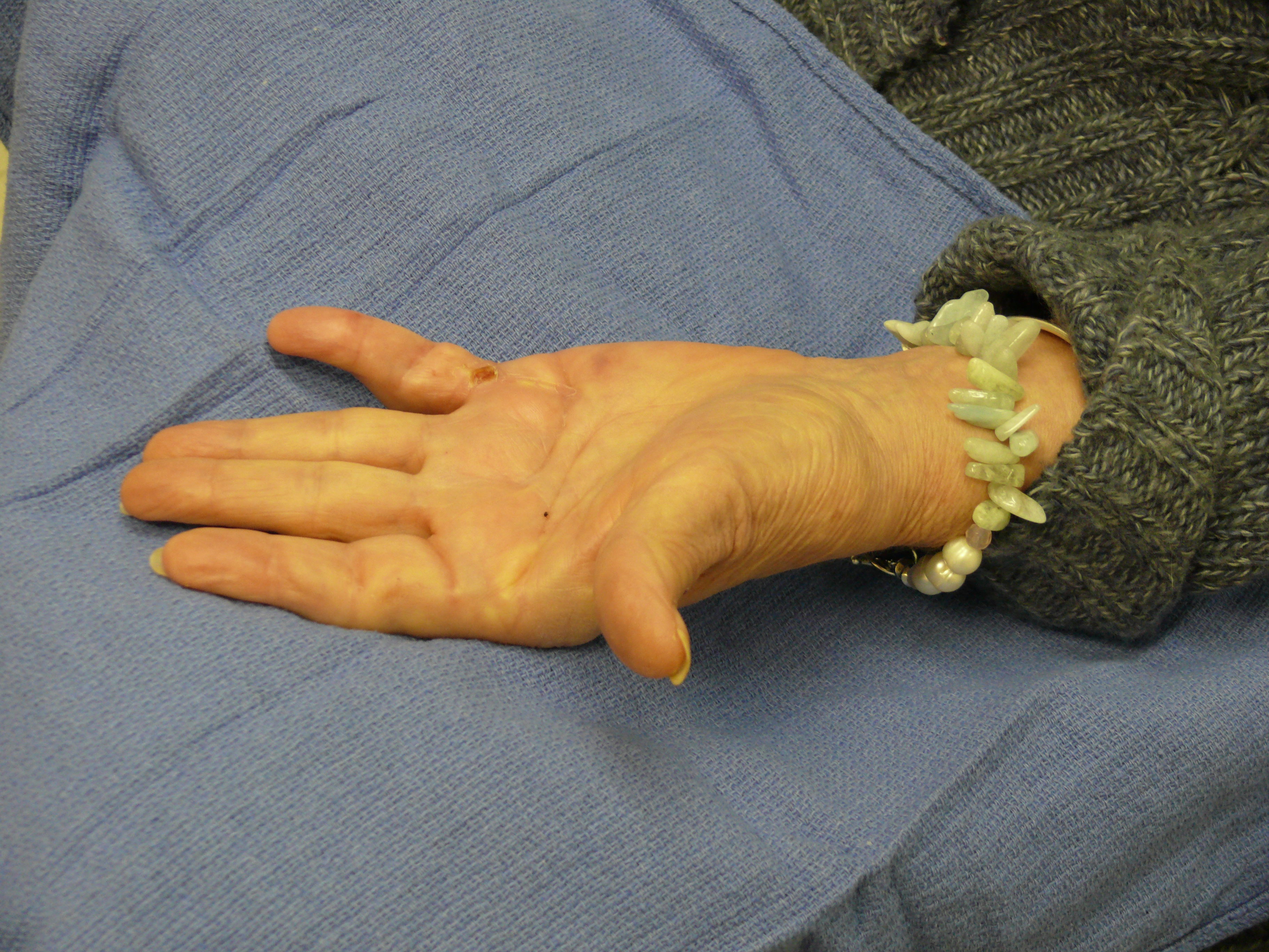 After Needle Fasciotomy