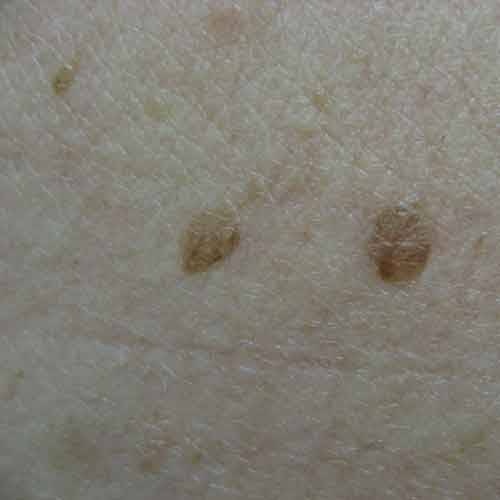 Benign Lesions