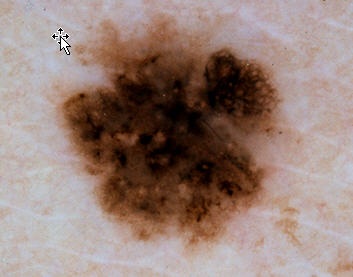Cancerous Lesion