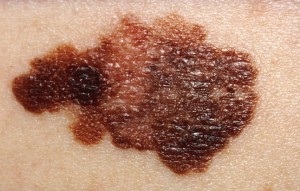 Cancerous Lesions