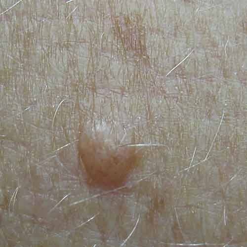 Benign Lesion