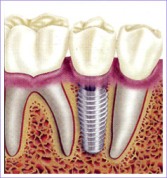 Dental Implant