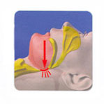 Obstructive Sleep Apnea