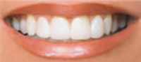 After Porcelain Dental Veneers - Dr Jim Wright - Holistic Cosmetic and General Las Vegas Dentist