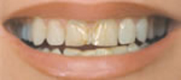 Before Porcelain Dental Veneers - Dr Jim Wright - Holistic Cosmetic and General Las Vegas Dentist