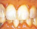Moderate Periodontitis