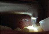 Laser Dentistry, Jamesburg, NJ