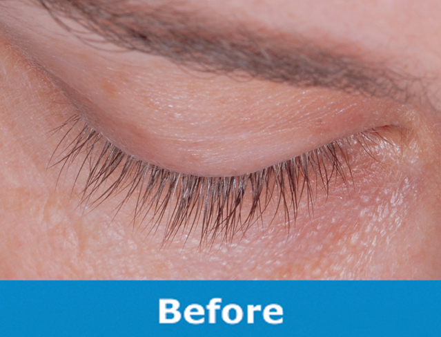 Before LATISSE™