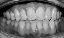 Invisalign