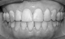 Results in 15 months - clear braces used