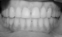 The Invisalign system is very efficient in closing spaces between the teeth