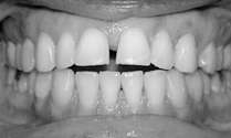 Invisalign