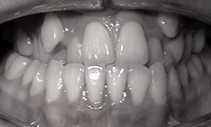 Underbite problem