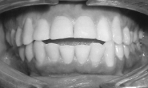 Openbite problem