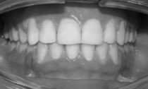 Results in 18 month of wearing clear braces