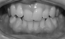 Invisalign Braces
