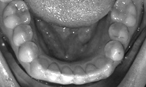 Invisible Braces