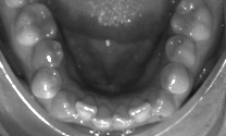 Teeth Braces