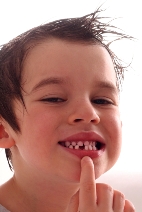 Orthodontic treatment helps to lower the risk of trauma to protruded front teeth