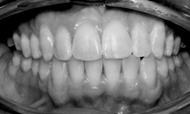 Invisalign Braces