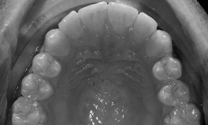Invisalign