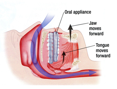 Sleep Apnea Dental Appliance