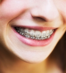 Orthodontics West Chester OH