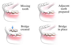 Dental bridge, Cincinnat OH Dentist
