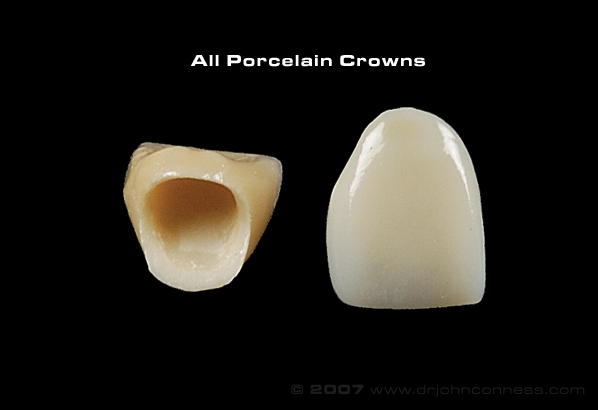 Dental Crowns, Dentist Cincinnati OH