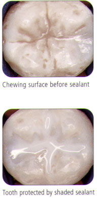 Dental Sealants Cincinnati Oh