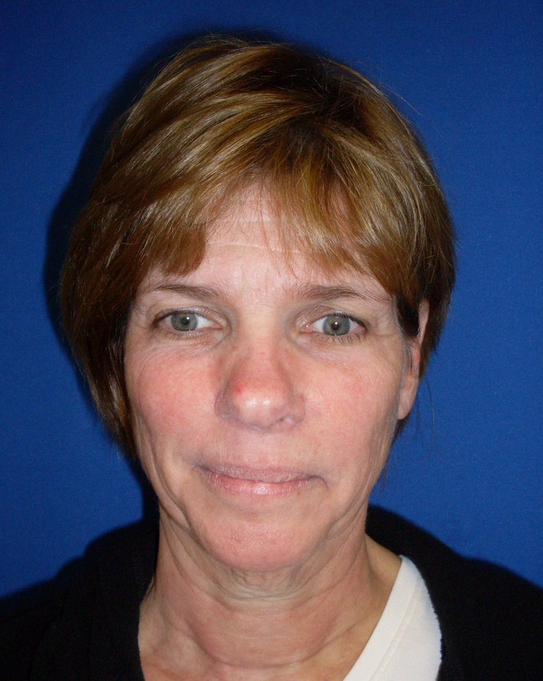 facelift before picture