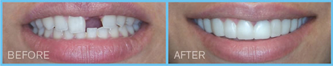 Humble Dentist Temporary Restoration