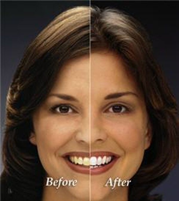 Humble Dentist Zoom Before and After