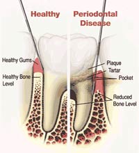 Gum Disease solutions fairfield ct