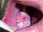 Oral Cancer