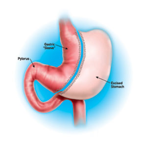 Gastric Sleeve Details