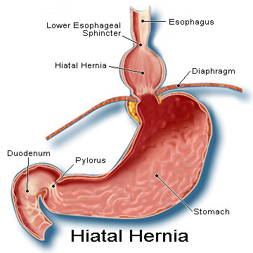 Hiatal Hernia