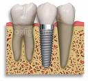 Dental Implants Replace Missing Teeth Recreating Your Smile