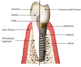 dental implants illustrations