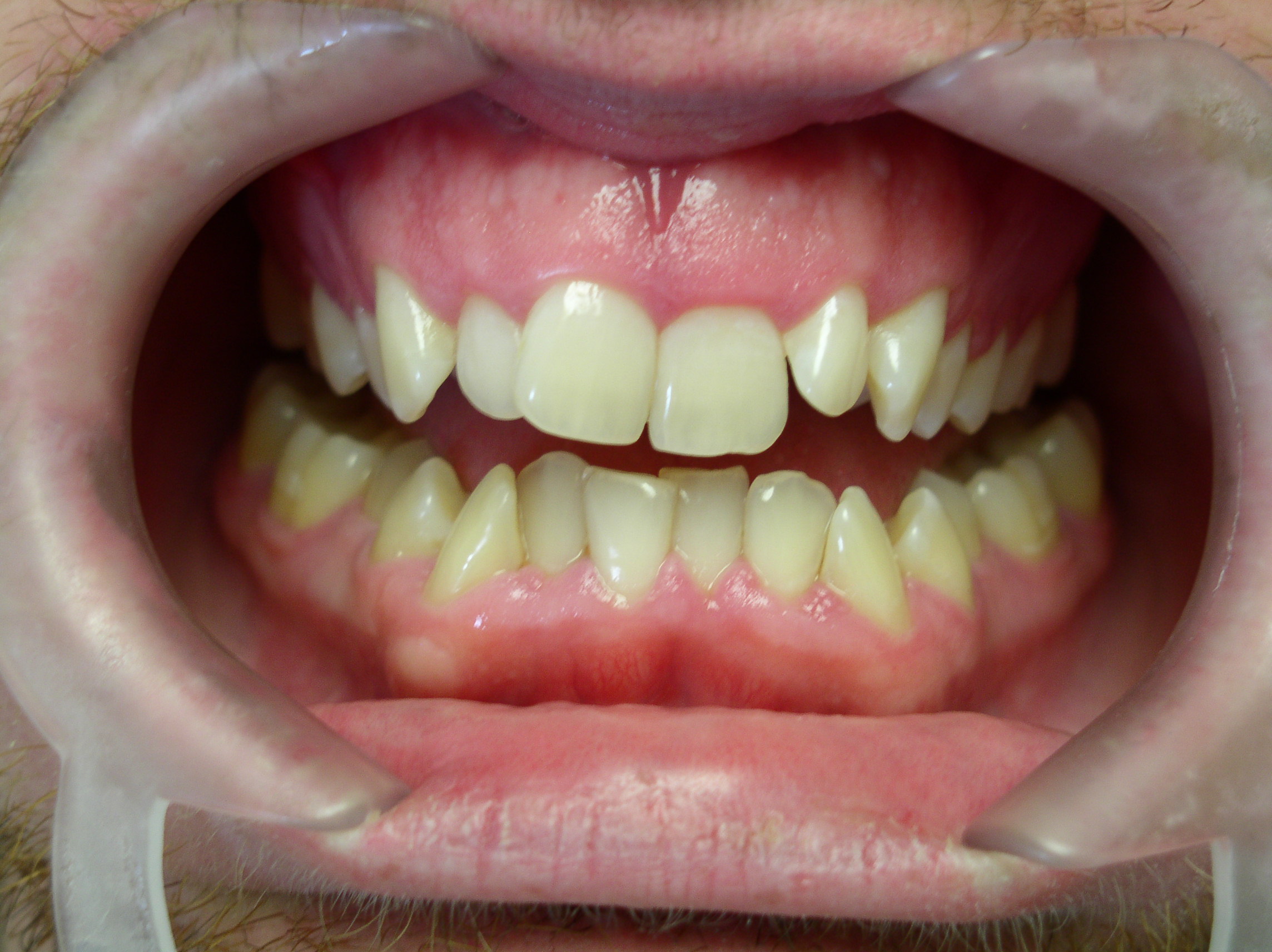 Before Invisalign