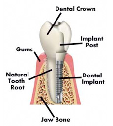 Dental Implants Middlesex info